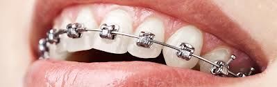 Bilde av tenner med tannregulering