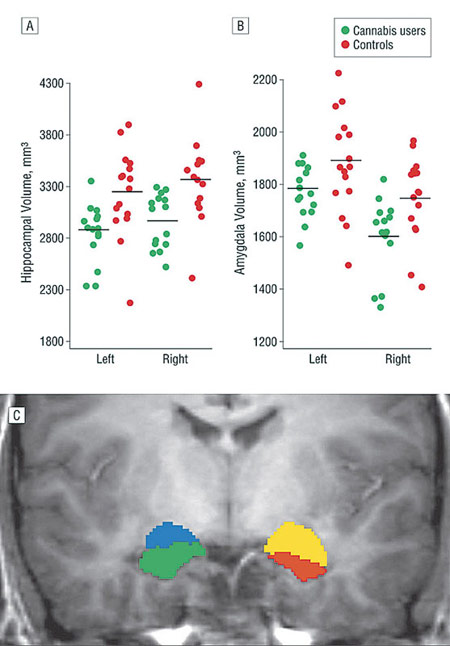 Måling av volum i hippocampus og amygdala hos tnge cannabisbrukere (MRI)